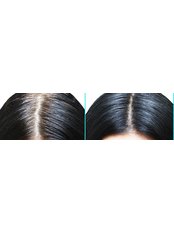 HRI - Hair Regrowth Injections - Cupping therapy in Delhi
