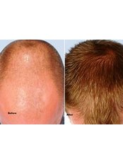 Hair Transplant - Cupping therapy in Delhi