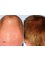 Cupping therapy in Delhi - Hair Loss Treatment, Call Us at 8287833547 
