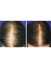 Treatment for Female Pattern Hair Loss - Cupping therapy in Delhi