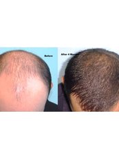 Hair Loss Treatment - Cupping therapy in Delhi
