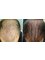 Cupping therapy in Delhi - Hair Loss Treatment 