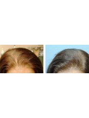 Treatment for Female Pattern Hair Loss - Cupping therapy in Delhi