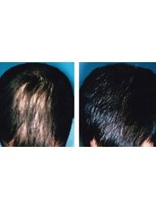 Hair Loss Treatment - Cupping therapy in Delhi