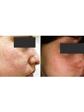 Laser Skin Resurfacing - Cupping therapy in Delhi