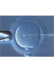 ICSI - Intracytoplasmic Sperm Injection - Fertility Clinic Puducherry