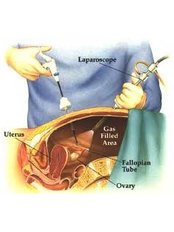 Tubal Surgery - Fertility Clinic Puducherry