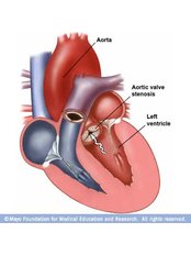 Aortic Valve Replacement - The Cardiac Surgeon