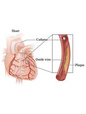 Coronary Catheterization and Stenting - The Cardiac Surgeon