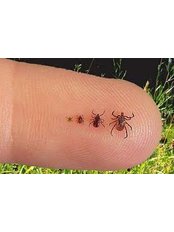 Tick Bite (Lyme Disease) Diagnosis & Management - RoyalMed Health Centre