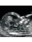 Babybond & Ultrasound Direct Manchester - NT Scan 