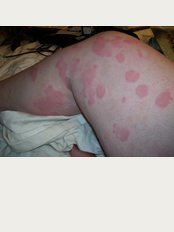 British Allergy Clinic - Hives
