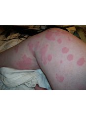 British Allergy Clinic - Hives 