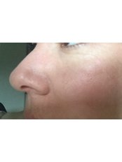 Mole Removal - The Wells Clinic