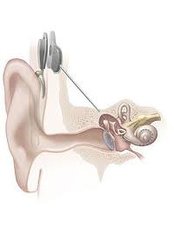 Cochlear Implants - Krishna Eye and Ent