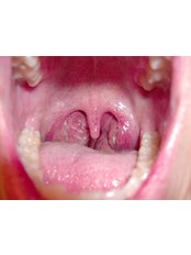 Tonsil Removal - GV ENT Clinic / The GV Nose clinic
