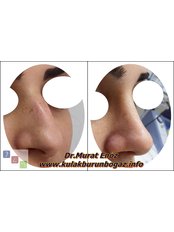 Rhinoplasty - Dr Murat Enoz, ENT Specialist - Private Office