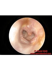 Ear Infection Treatment - Dr Murat Enoz, ENT Specialist - Private Office