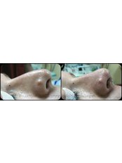 Nasal Tip Surgery - Dr Murat Enoz, ENT Specialist - Private Office