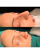 Nasal Tip Surgery - Assoc. Prof. Dr. H. Baki Yilmaz