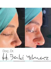 Nasal Tip Surgery - Assoc. Prof. Dr. H. Baki Yilmaz
