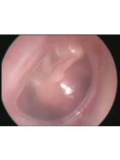 Ear Infection Treatment - Dr. Atilla Sengor