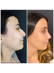 Rhinoplasty - Dr. Can Ercan Clinic