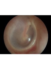 Ear Syringing - Marlow - Crystal Hearing