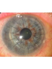 Corneal Surgery - Eye Surgeons SA