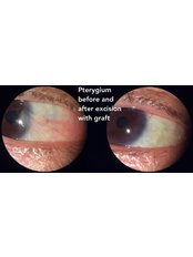 Pterygium - Eye Surgeons SA