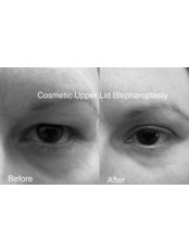 Blepharoplasty - Eye Surgeons SA