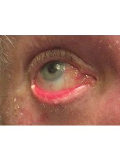 Ectropion or Entropion Repair  - Eye Surgeons SA