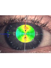 Cataract Treatment - Eye Surgeons SA