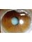 Instant Eye Care - Cataract before operation 