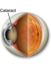 Cataract Treatment - Eye Care Bangalore