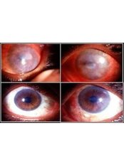 Corneal Transplant - Eye Care Bangalore