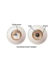 Corneal Transplant - Eye Care Bangalore