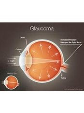 Glaucoma Treatment - Karthik Netralaya