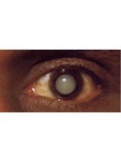 Cataract Treatment - Karthik Netralaya