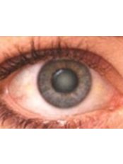 Cataract Treatment - Sunetra Eye Laser and Dental Care