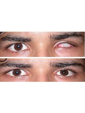 Prosthetic - Eyes - Chinmaya Custom Artificial Eyes