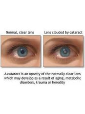 Intraocular Lenses - Eye Clinic Delhi
