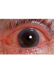 Glaucoma Treatment - Eye Clinic Delhi