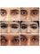Global Prosthetic Eye Center ,Delhi - custom Made Artificial eye  
