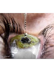 Eye drops - Opticalrooms Blanchardstown