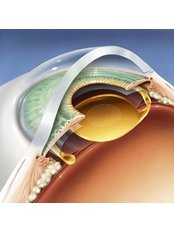 Cataract Treatment - International Specialist Eye Centre - Ampang