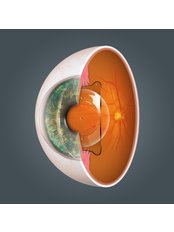 Implanted Collamer Lenses ICL surgery - James McKelvie, Specialist Eye Surgeon