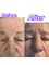 Dr Mehruz Cevadzade Eye care and Cosmetic Eye surgery Clinic - Blepharoplasty 