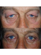 Blepharoplasty - Clearvision Medicare