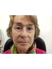 Brow Lift - Clearvision Medicare